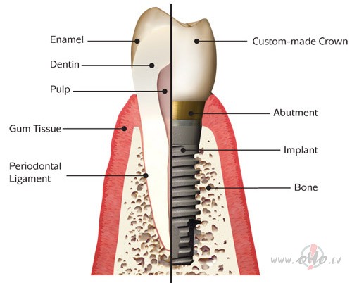 Zoba implants